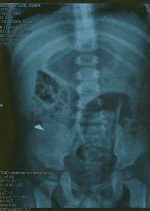 Imagen de la radiografía de Asier, donde se aprecia la cuchilla. :: E. C./
